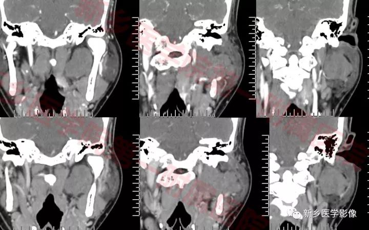 【病例】腮腺多形性腺瘤1例CT影像表现