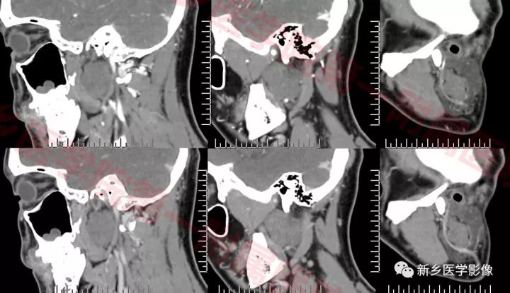 【病例】腮腺多形性腺瘤1例CT影像表现