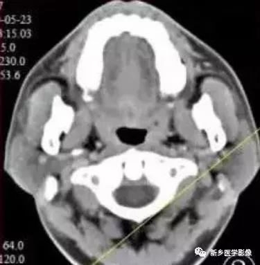 【病例】腮腺多形性腺瘤1例CT影像表现