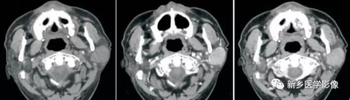 【病例】腮腺多形性腺瘤1例CT影像表现