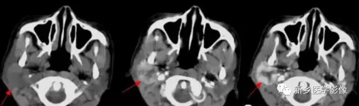【病例】腮腺多形性腺瘤1例CT影像表现
