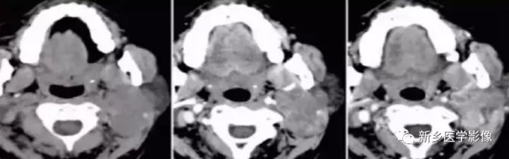 【病例】腮腺多形性腺瘤1例CT影像表现