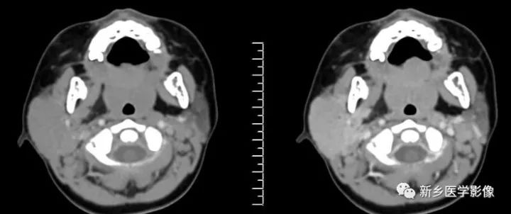 【病例】腮腺多形性腺瘤1例CT影像表现
