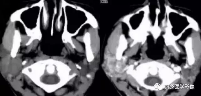 【病例】腮腺多形性腺瘤1例CT影像表现