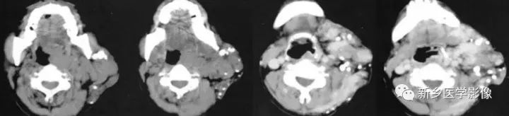【病例】腮腺多形性腺瘤1例CT影像表现
