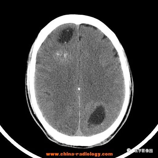 【病例】脑转移瘤1例CT及MR影像表现 【病例】脑转移瘤1例CT及MR影像表现