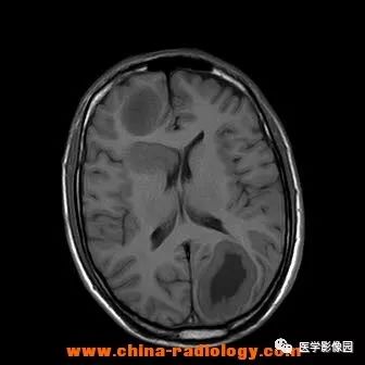 【病例】脑转移瘤1例CT及MR影像表现 【病例】脑转移瘤1例CT及MR影像表现