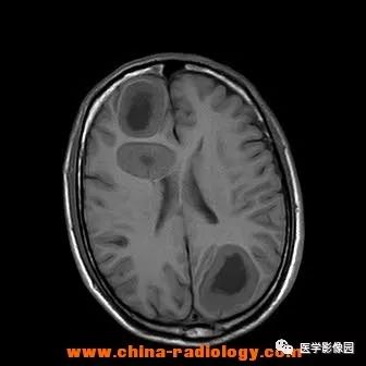 【病例】脑转移瘤1例CT及MR影像表现 【病例】脑转移瘤1例CT及MR影像表现