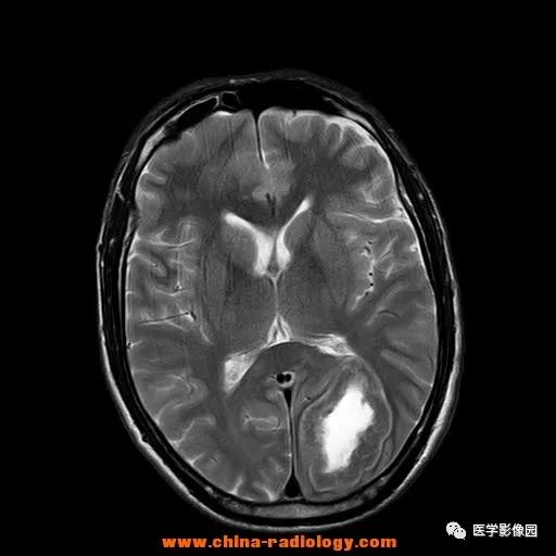 【病例】脑转移瘤1例CT及MR影像表现 【病例】脑转移瘤1例CT及MR影像表现