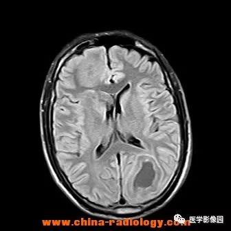 【病例】脑转移瘤1例CT及MR影像表现 【病例】脑转移瘤1例CT及MR影像表现
