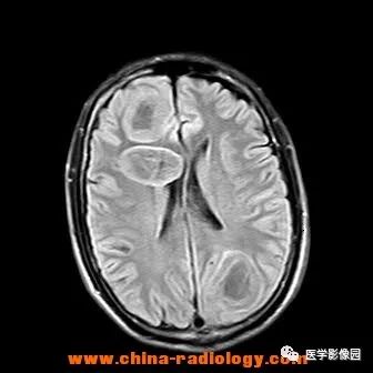 【病例】脑转移瘤1例CT及MR影像表现 【病例】脑转移瘤1例CT及MR影像表现