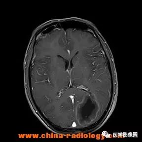 【病例】脑转移瘤1例CT及MR影像表现 【病例】脑转移瘤1例CT及MR影像表现