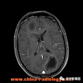 【病例】脑转移瘤1例CT及MR影像表现 【病例】脑转移瘤1例CT及MR影像表现