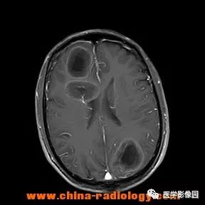 【病例】脑转移瘤1例CT及MR影像表现 【病例】脑转移瘤1例CT及MR影像表现