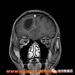 【病例】脑转移瘤1例CT及MR影像表现 【病例】脑转移瘤1例CT及MR影像表现