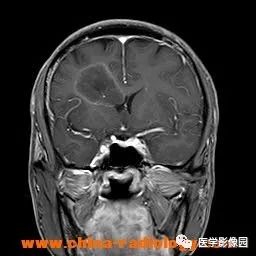 【病例】脑转移瘤1例CT及MR影像表现 【病例】脑转移瘤1例CT及MR影像表现