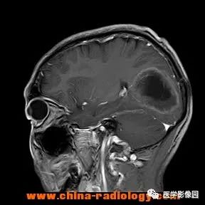 【病例】脑转移瘤1例CT及MR影像表现 【病例】脑转移瘤1例CT及MR影像表现