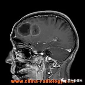 【病例】脑转移瘤1例CT及MR影像表现 【病例】脑转移瘤1例CT及MR影像表现