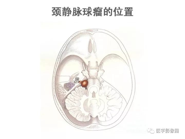【PPT】颈静脉球瘤影像表现