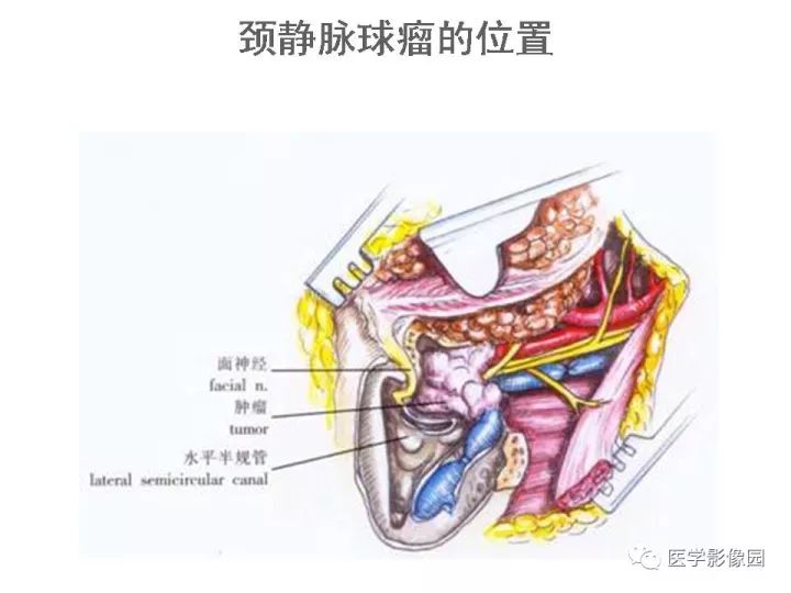 【PPT】颈静脉球瘤影像表现