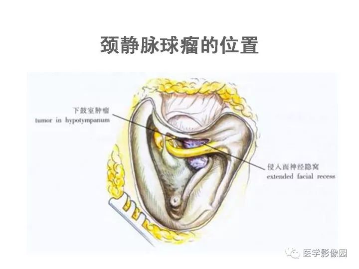 【PPT】颈静脉球瘤影像表现