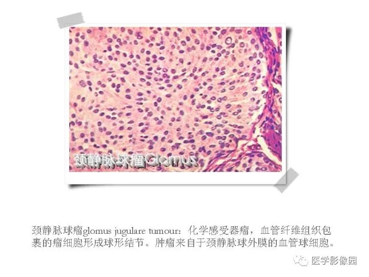 【PPT】颈静脉球瘤影像表现
