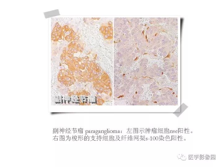 【PPT】颈静脉球瘤影像表现
