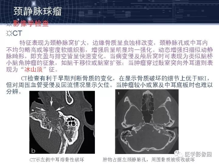 【PPT】颈静脉球瘤影像表现