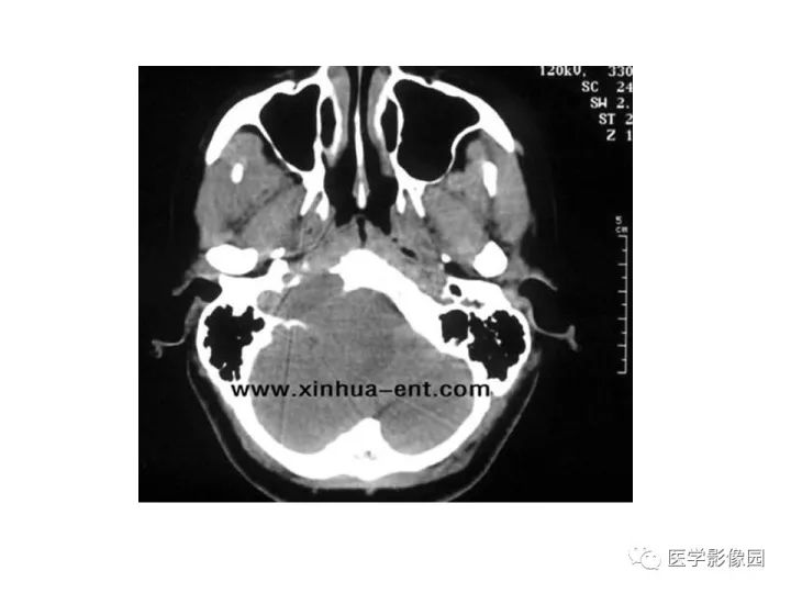 【PPT】颈静脉球瘤影像表现