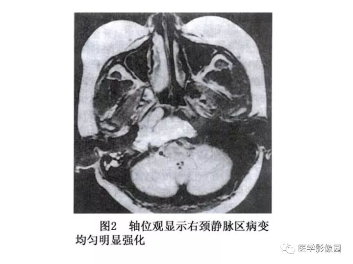 【PPT】颈静脉球瘤影像表现
