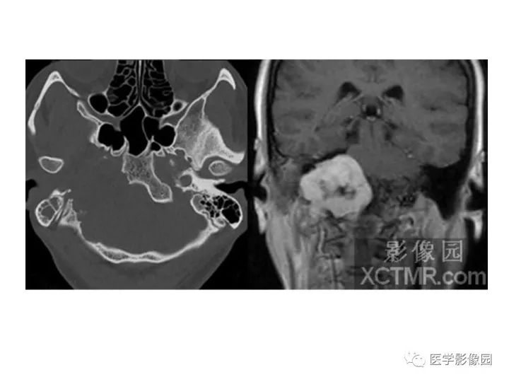 【PPT】颈静脉球瘤影像表现