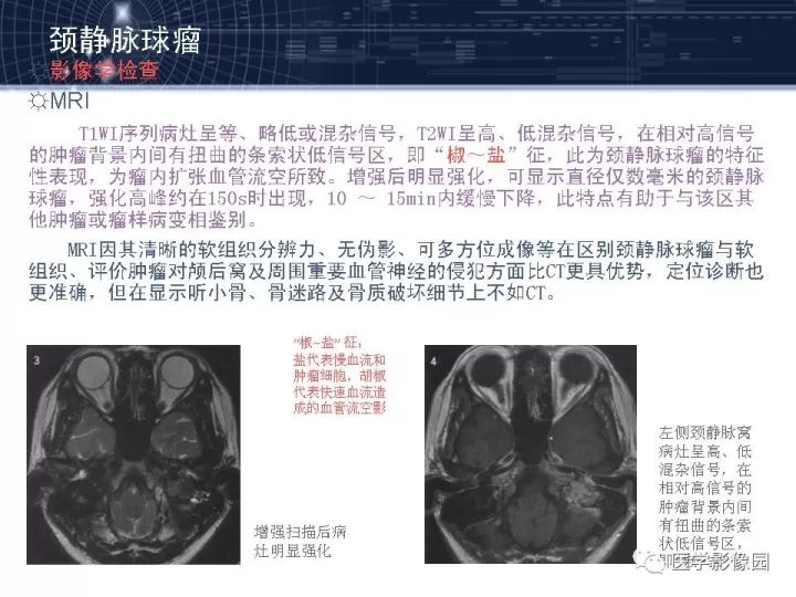 【PPT】颈静脉球瘤影像表现