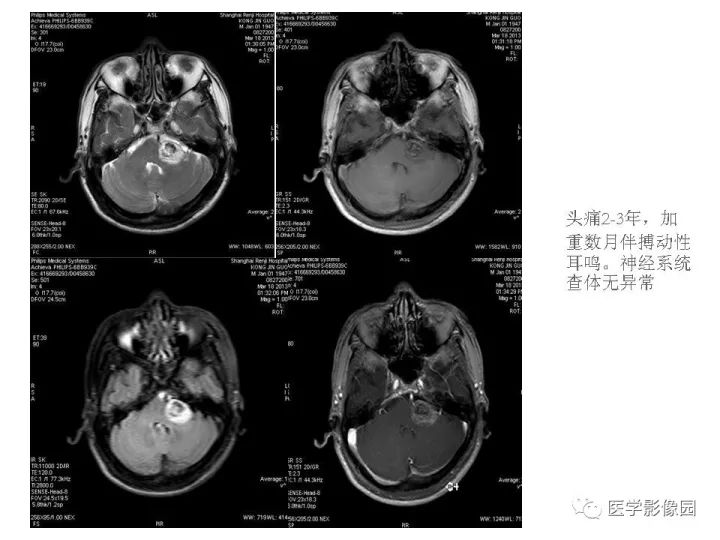 【PPT】颈静脉球瘤影像表现
