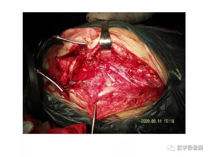 【PPT】颈静脉球瘤影像表现