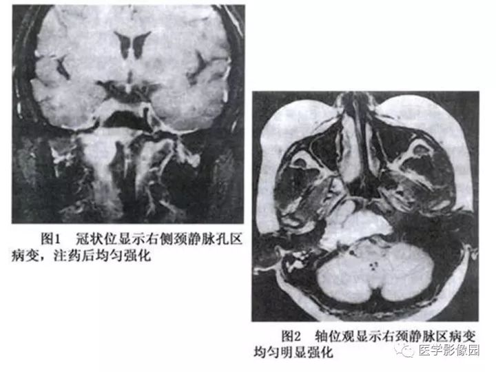 【PPT】颈静脉球瘤影像表现