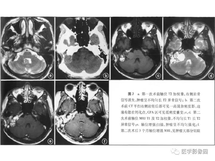 【PPT】颈静脉球瘤影像表现
