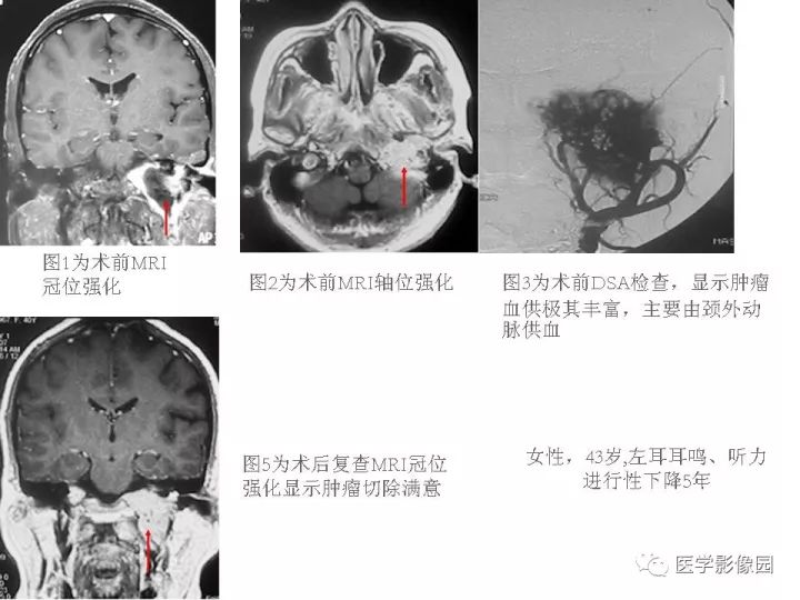 【PPT】颈静脉球瘤影像表现