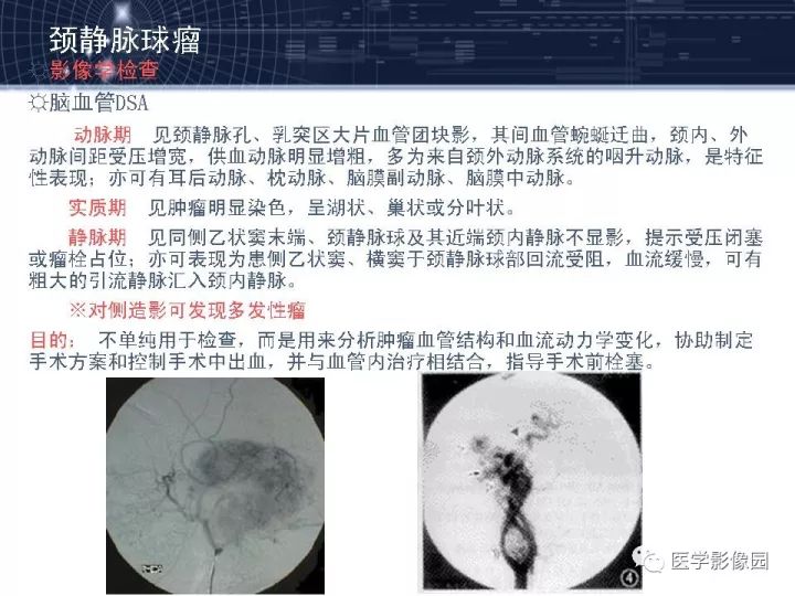 【PPT】颈静脉球瘤影像表现