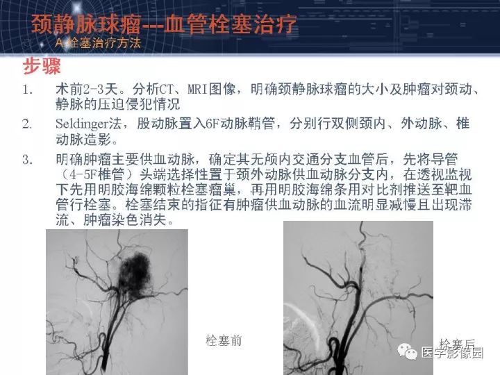 【PPT】颈静脉球瘤影像表现