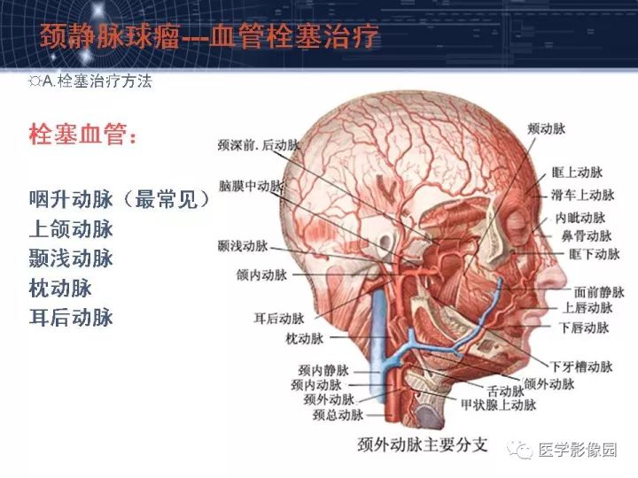 【PPT】颈静脉球瘤影像表现