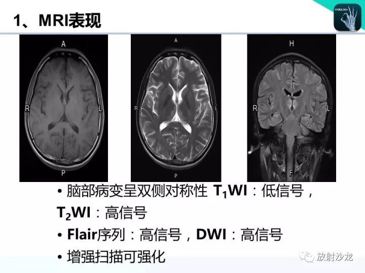 【病例】Wernicke脑病1例MR