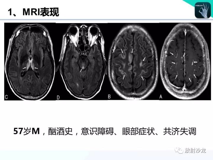【病例】Wernicke脑病1例MR