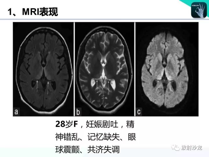 【病例】Wernicke脑病1例MR