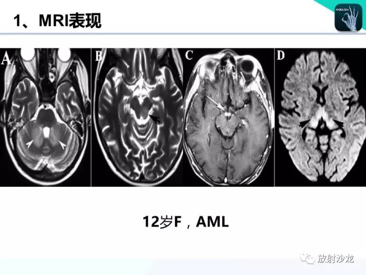 【病例】Wernicke脑病1例MR
