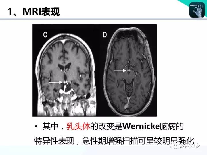 【病例】Wernicke脑病1例MR