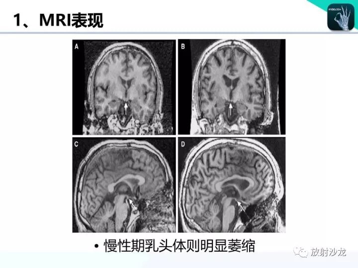 【病例】Wernicke脑病1例MR