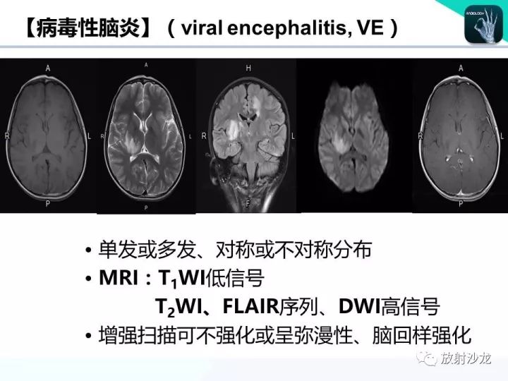 【病例】Wernicke脑病1例MR