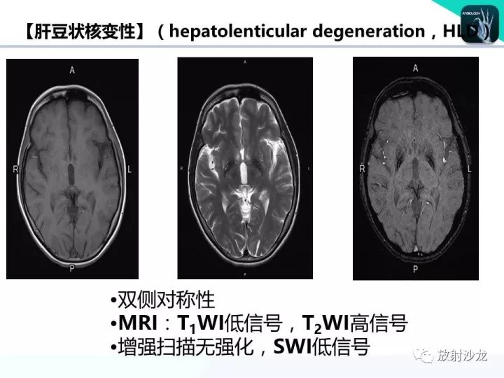【病例】Wernicke脑病1例MR
