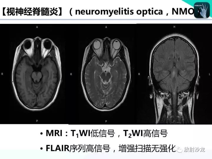 【病例】Wernicke脑病1例MR