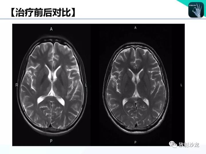 【病例】Wernicke脑病1例MR